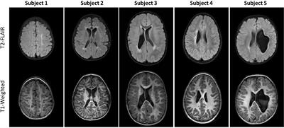 Changes in diffusion MRI and clinical motor function after physical/occupational therapies in toddler-aged children with spastic unilateral cerebral palsy